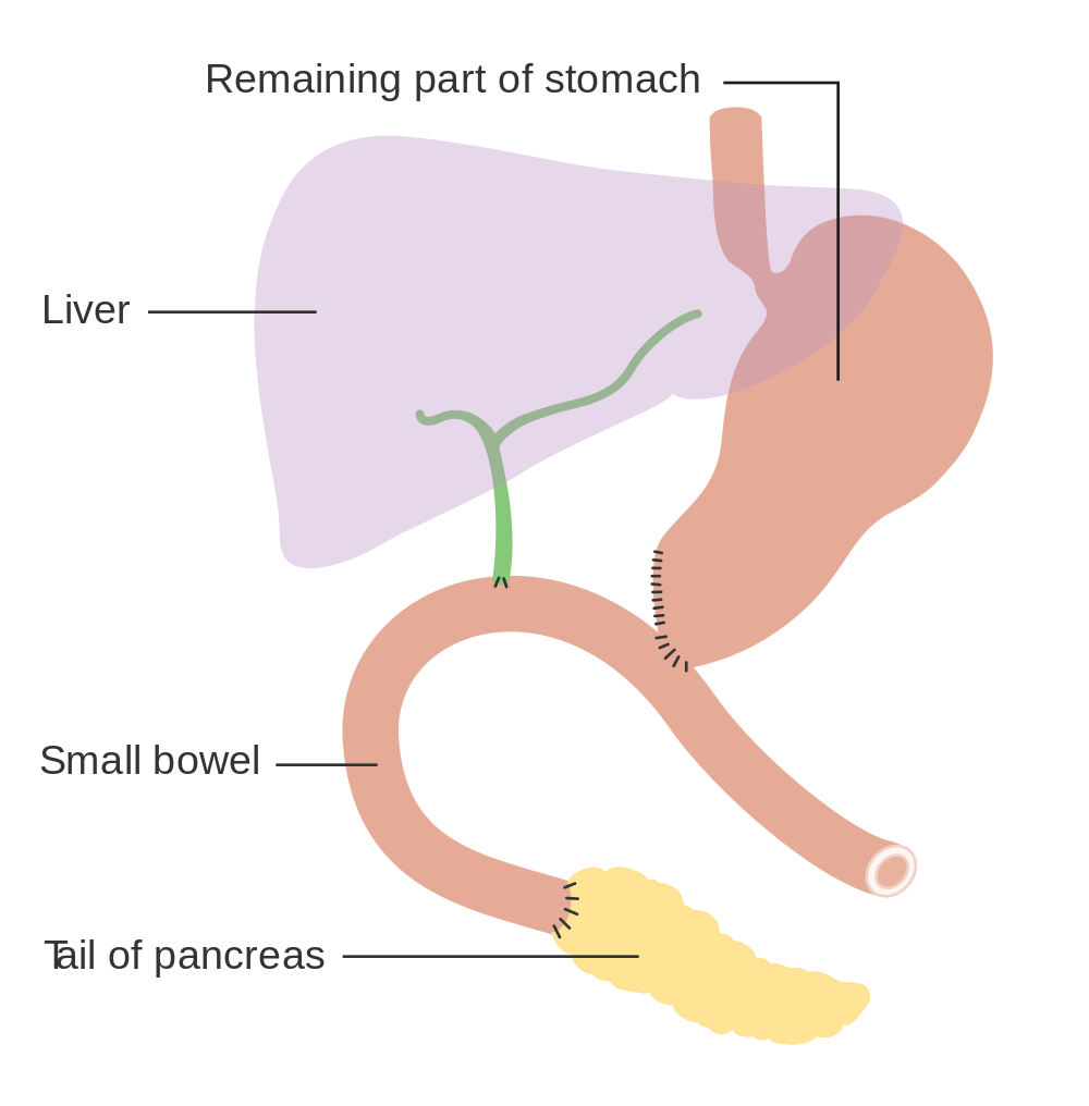 whipple procedure animation